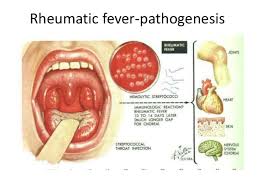 Rheumatic fever - Hình ảnh minh họa